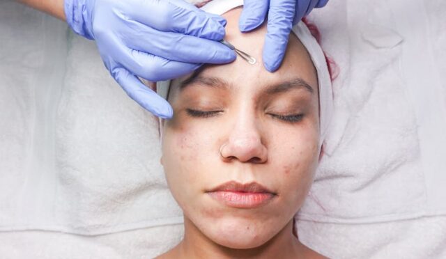 Sivilce hakkında görsel - sivilce